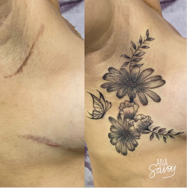 Cobertura de Cicatriz com Tatuagem Personalizada